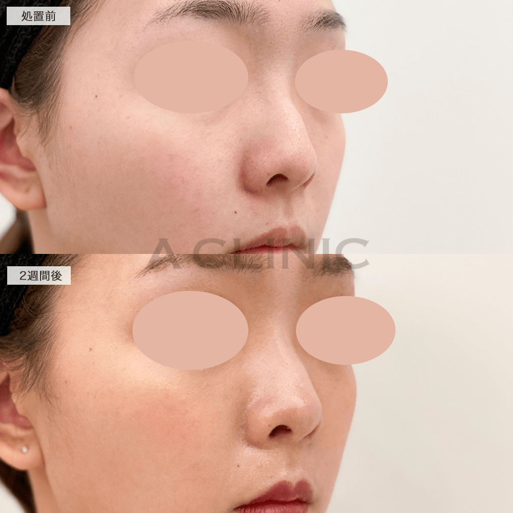 半永久的に理想的なＥラインが叶う！耳介軟骨移植(鼻尖形成)の処置前と2週間後の症例です(20代女性)