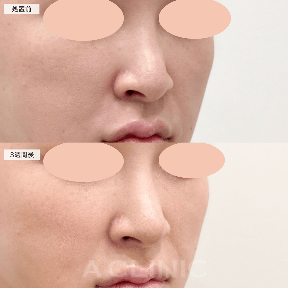 ツンとした鼻先で横顔も美しい印象に♪耳介軟骨移植(鼻尖形成)の処置前と3週間後の症例です(30代女性)
