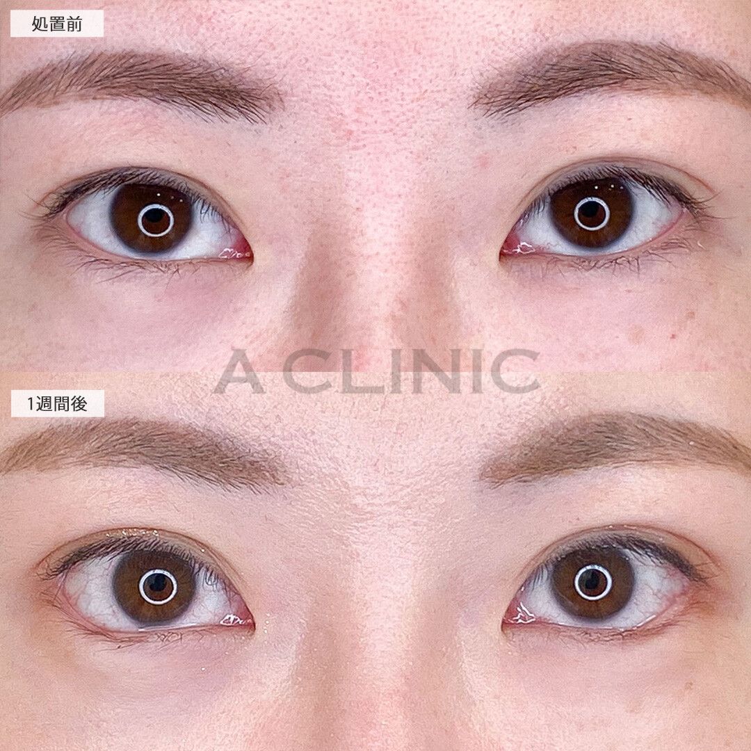 たれ目効果で優しい印象のお目元に！パーフェクトアイズの処置前と1週間後の症例です(30代女性)