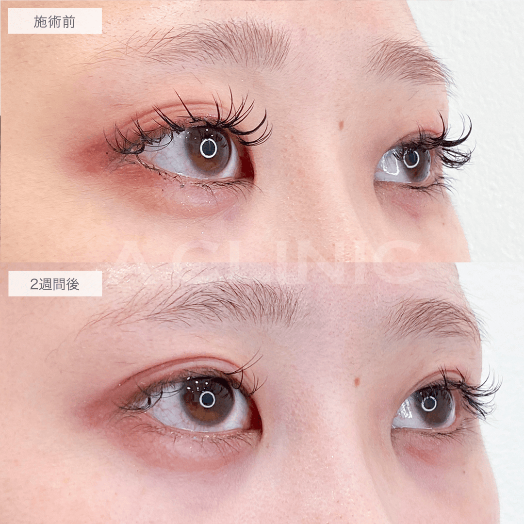 つり目から優しい印象のタレ目に！パーフェクトアイズの処置前と2週間後の症例です(20代女性)