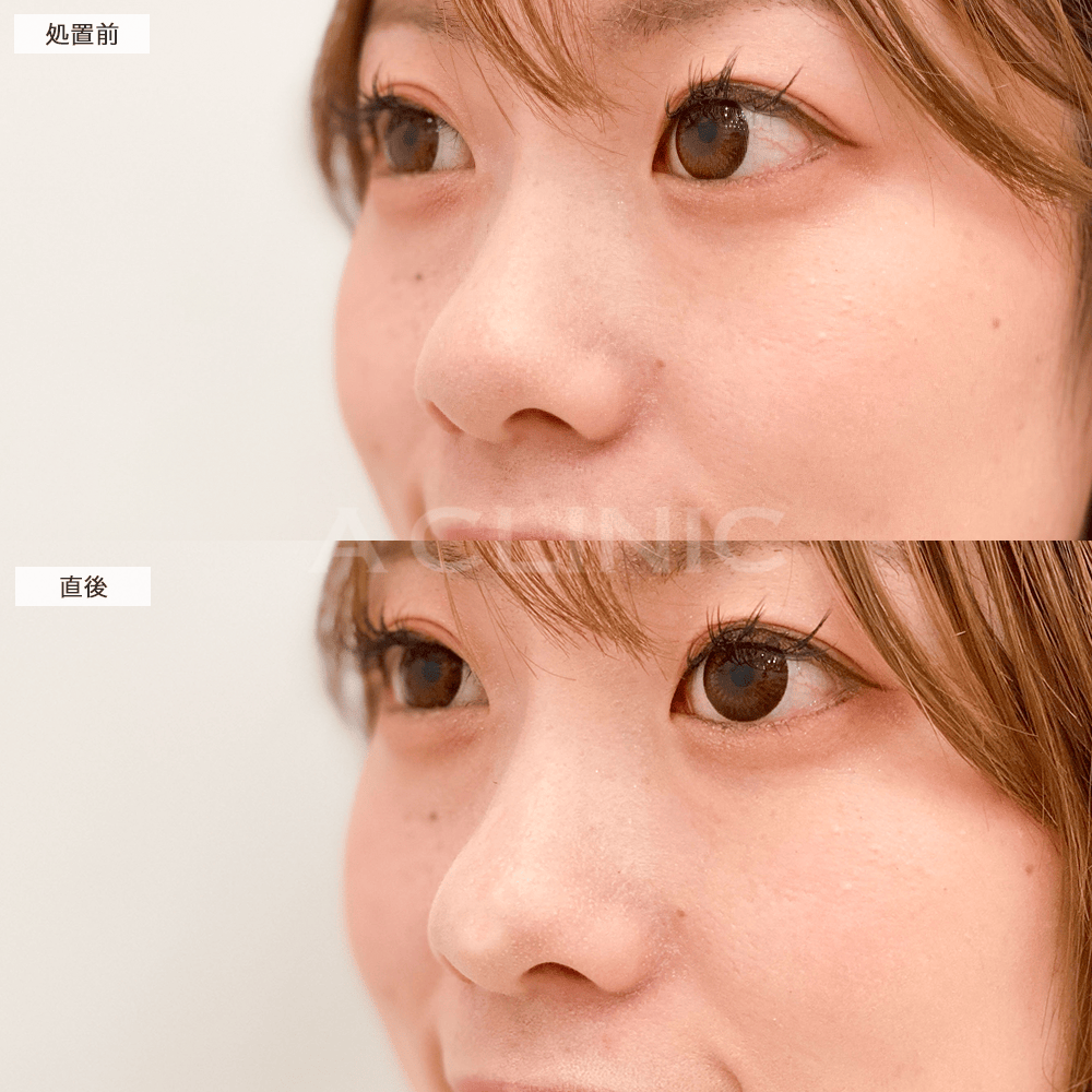 ヒアルロン酸注入のみで鼻先の形を整えて横顔もさらに美しく♪こちらコリアンノーズの処置前と直後の症例です(20代女性)