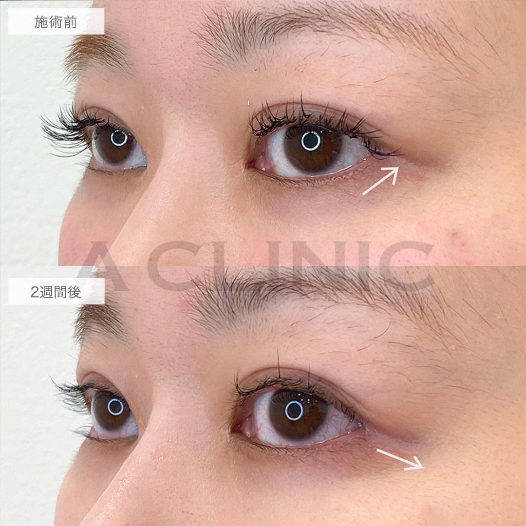 目尻切開とたれ目形成術で目のバランスが整う！パーフェクトアイズの処置前と2週間後の症例です(30代女性)