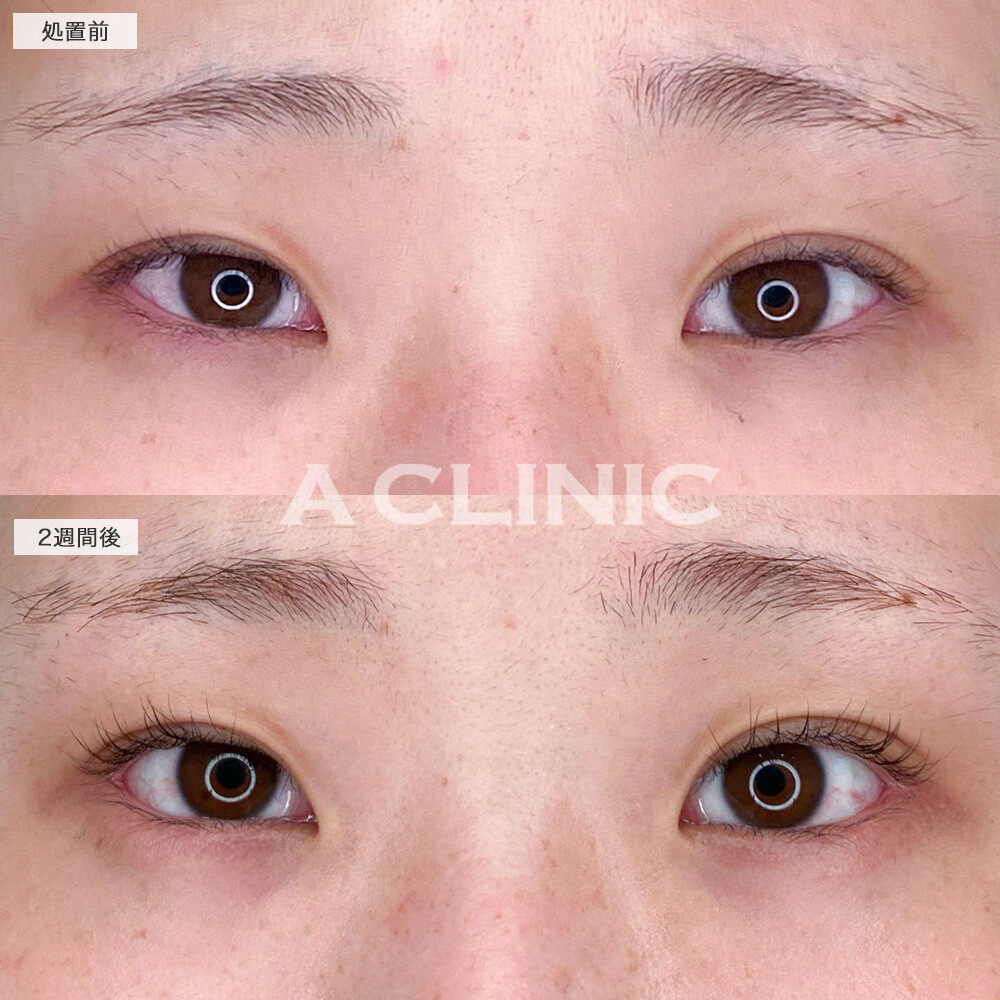 デカ目効果抜群のパーフェクトアイズおすすめです！こちら処置前と2週間後の症例です(20代女性)