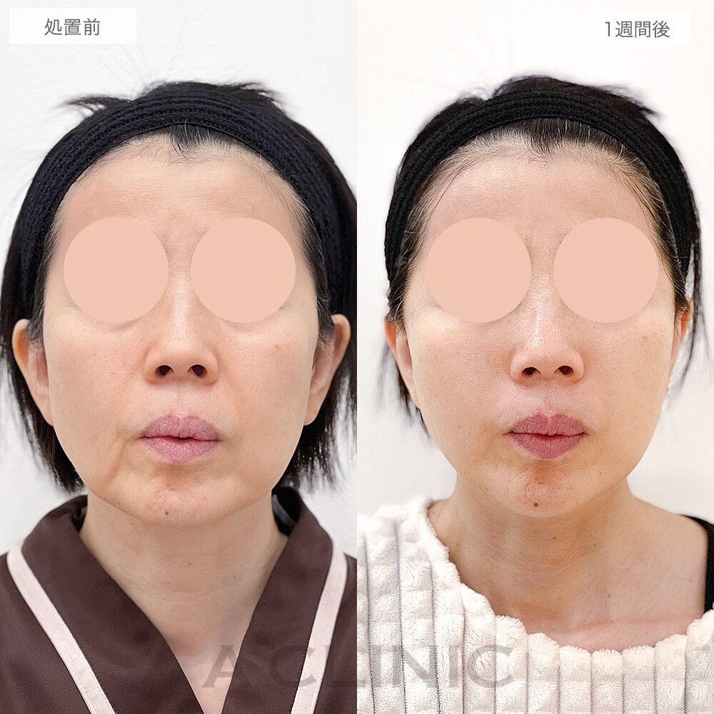 しっかり引き上がり若見え効果抜群！A式美肌たるみ切開の処置前と1週間後の症例です(50代女性)