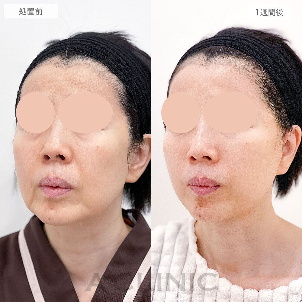 しっかり引き上がり若見え効果抜群！A式美肌たるみ切開の処置前と1週間後の症例です(50代女性)