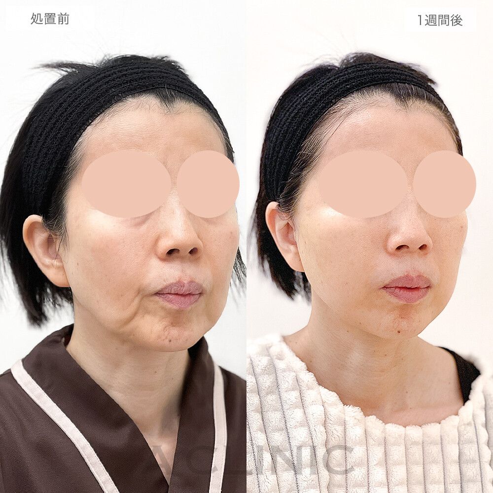 しっかり引き上がり若見え効果抜群！A式美肌たるみ切開の処置前と1週間後の症例です(50代女性)