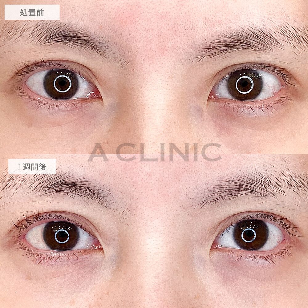 デカ目効果抜群のパーフェクトアイズで華やかなお目元に！処置前と1週間後の症例です(30代女性)
