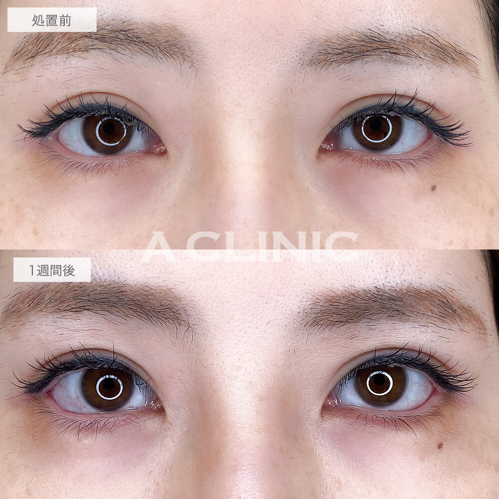 縦幅が広がってデカ目効果抜群！パーフェクトアイズの処置前と1週間後の症例です(30代女性)
