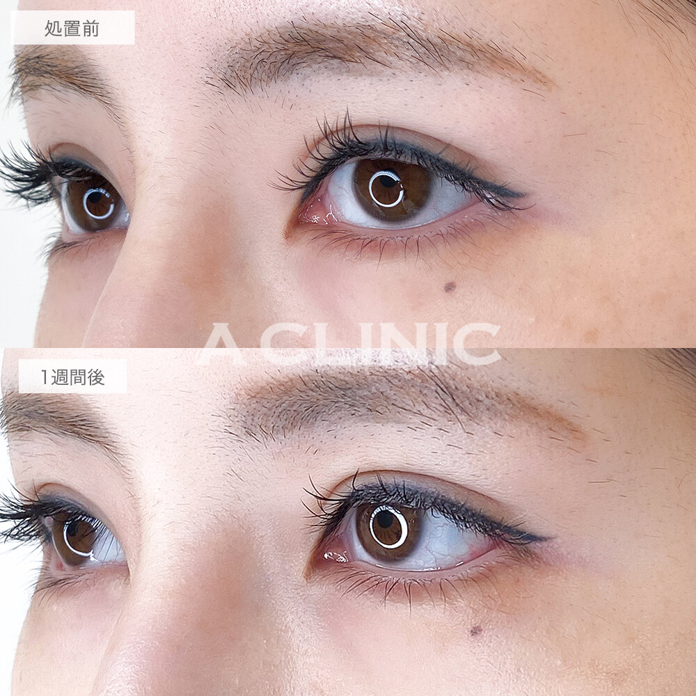 縦幅が広がってデカ目効果抜群！パーフェクトアイズの処置前と1週間後の症例です(30代女性)