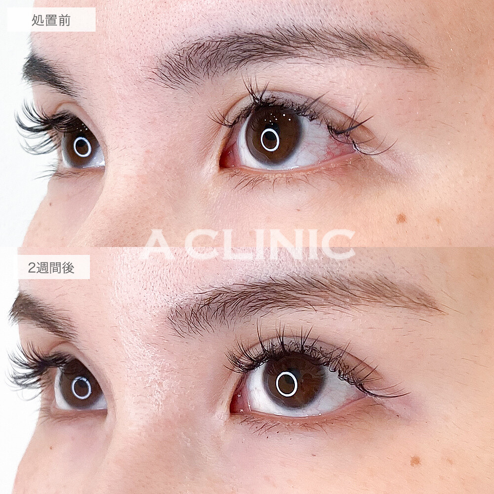 目の幅が広がりデカ目効果抜群です！パーフェクトアイズの処置前と2週間後の症例です(30代女性)