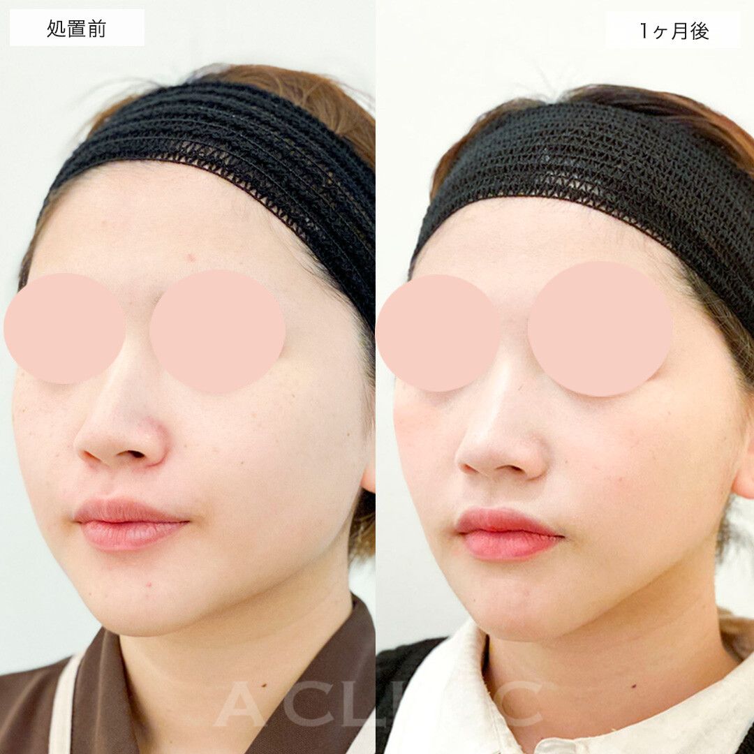 1day小顔脂肪吸引とバッカルファット除去術でお悩み解消くっきりVフェイスに!こちら処置前から1ヶ月後の症例です(20代女性)
