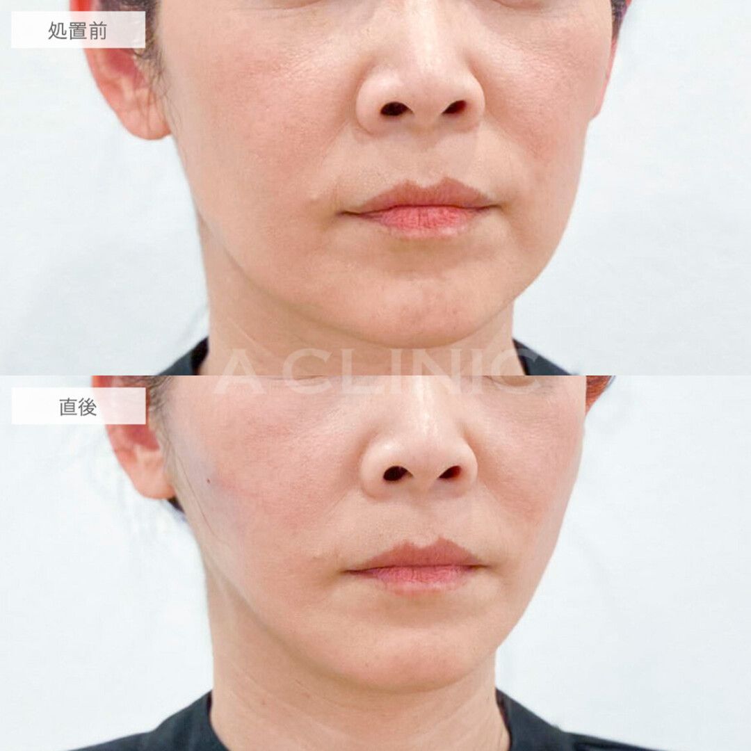 Aスレッドとエッグフェイスで理想のフェイスラインに！こちら処置前と直後の症例です(40代女性)