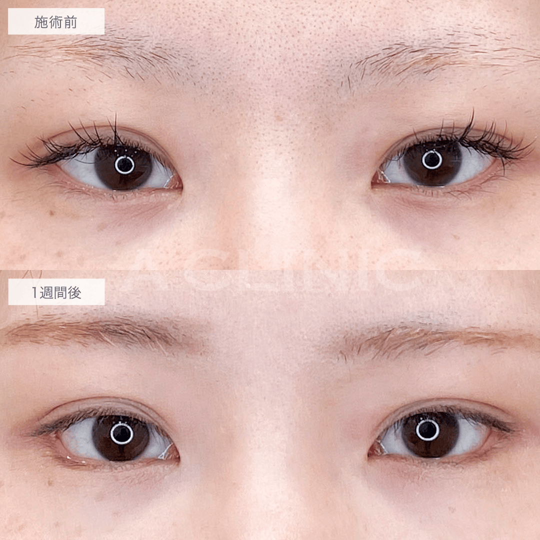 目の幅が広がり優しげな印象の目元に変化！処置前と1週間後の症例です(20代女性)