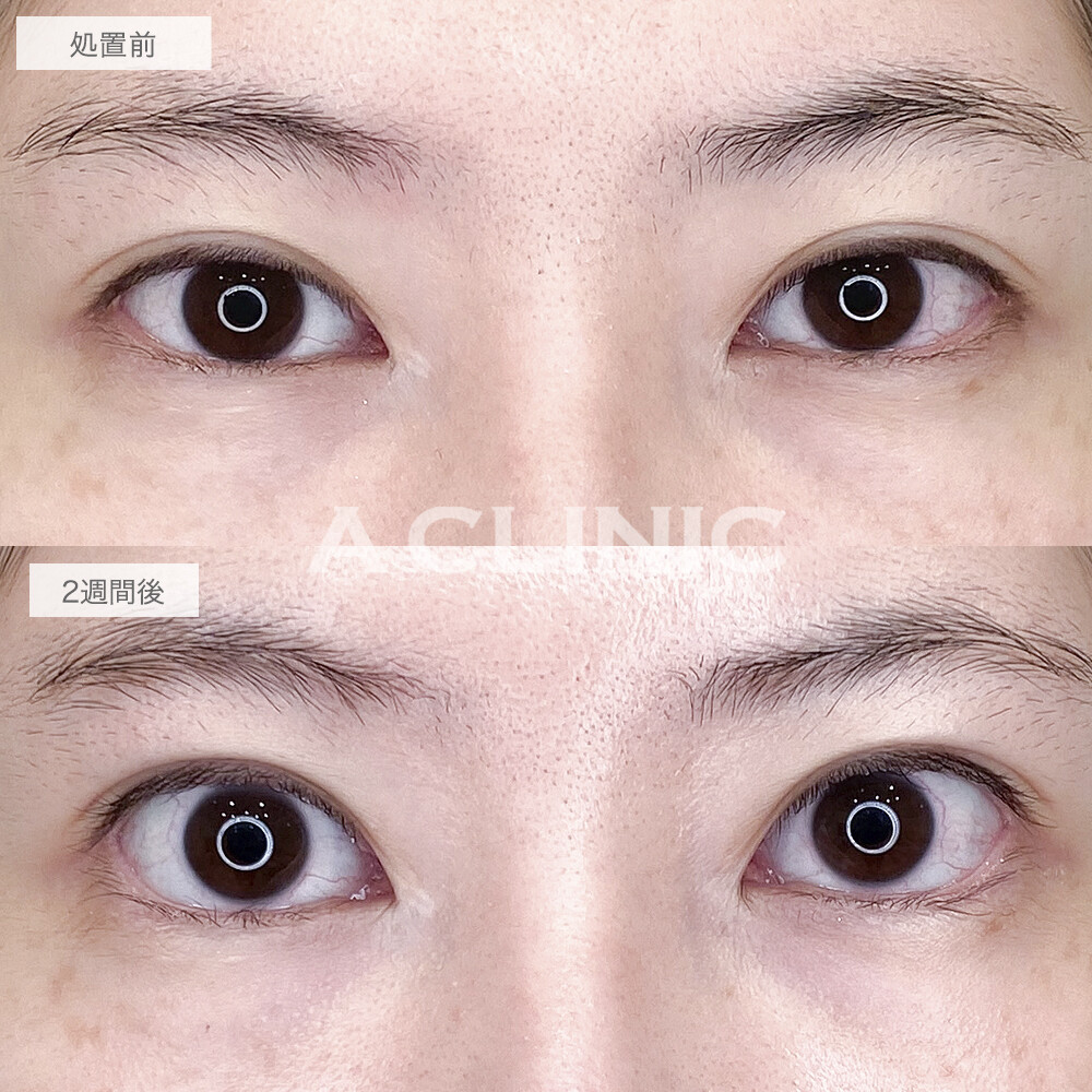 白目の範囲が拡大して印象的なお目元に！パーフェクトアイズの処置前と2週間後の症例です(20代女性)