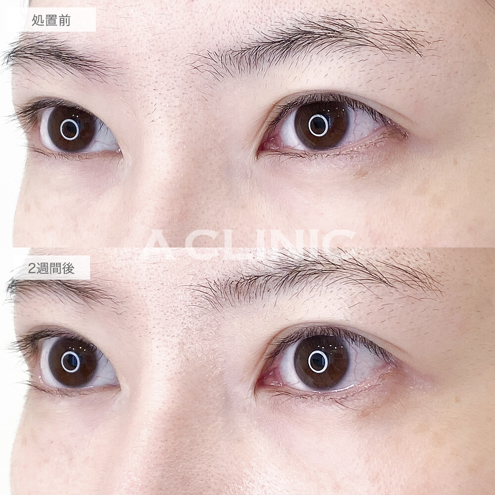 白目の範囲が拡大して印象的なお目元に！パーフェクトアイズの処置前と2週間後の症例です(20代女性)