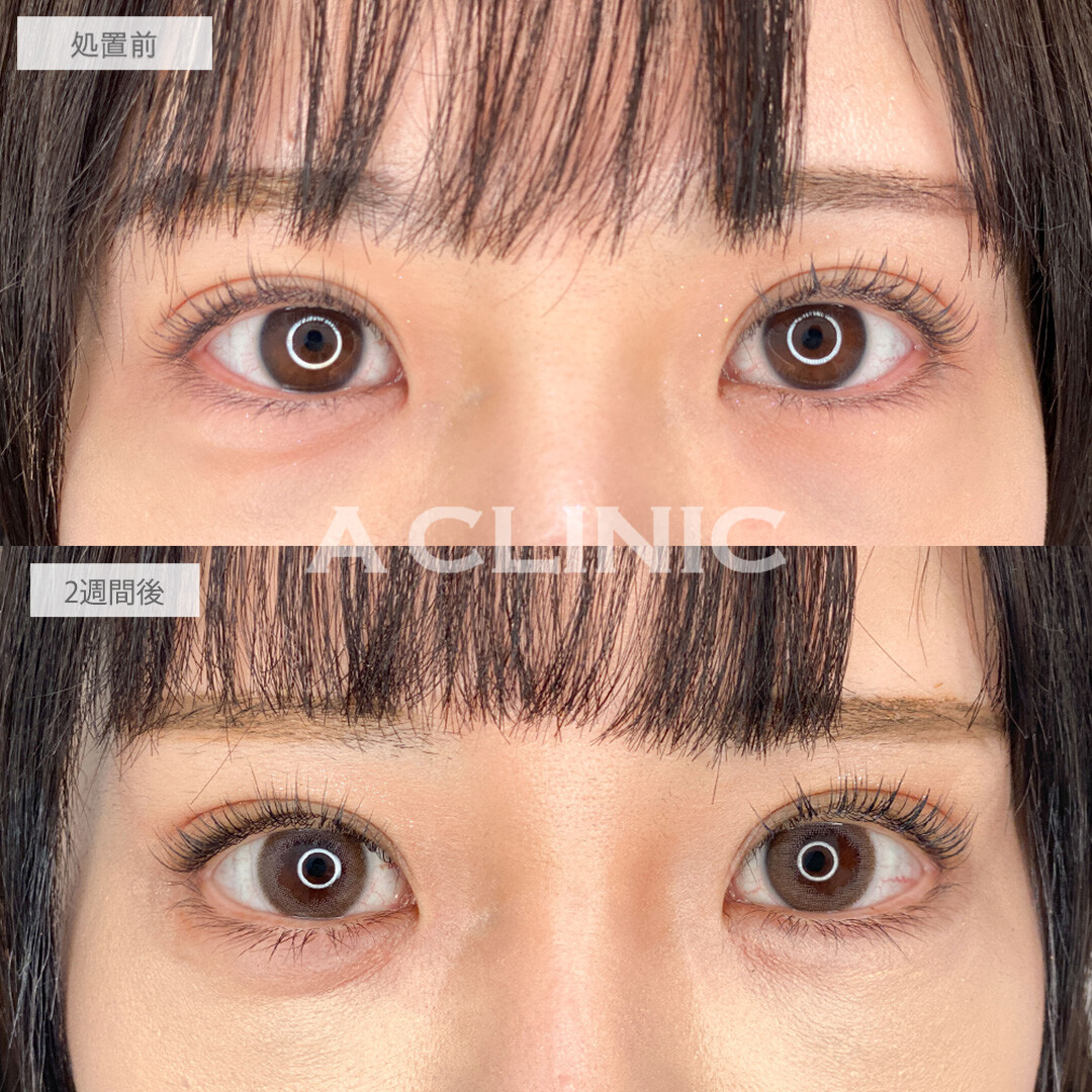 たれ目で優しい印象に！パーフェクトアイズの処置前と2週間後の症例です(30代女性)