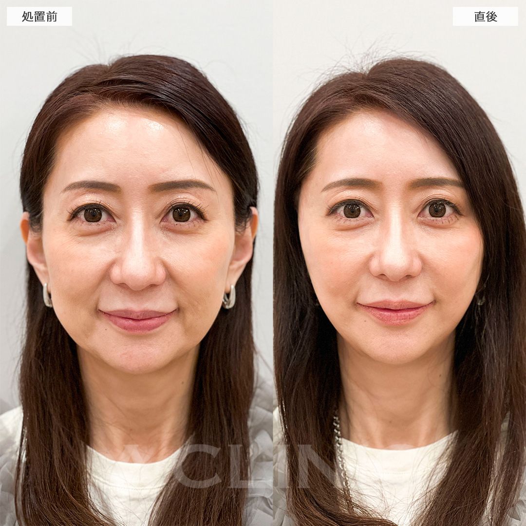 フェイスリフト直後でこの腫れ感！こちらA式美肌たるみ切開の処置前と直後の症例です(50代女性)