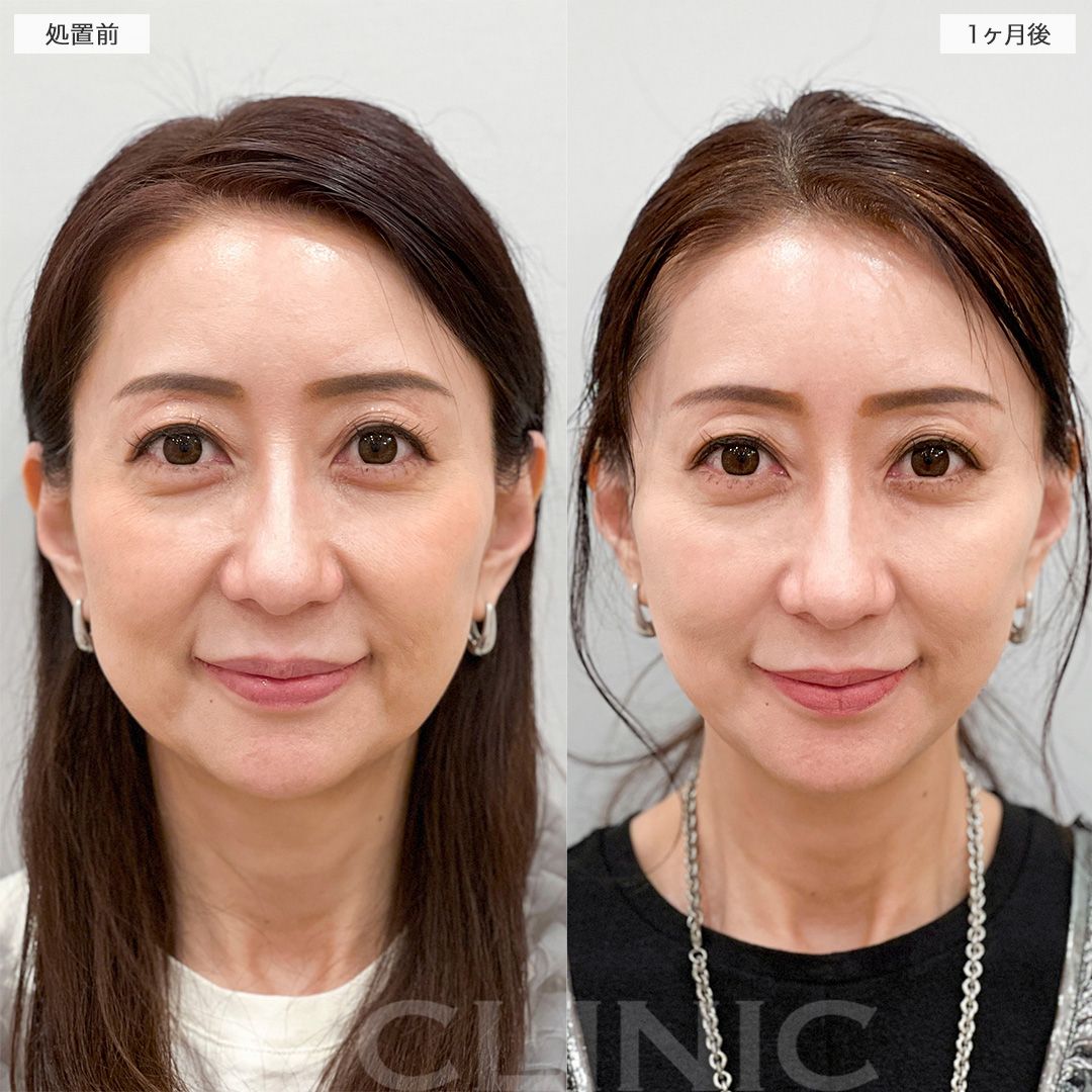 A式美肌たるみ切開でマイナス10歳のフェイスラインに！こちら処置前から1ヶ月後の症例です(50代女性)