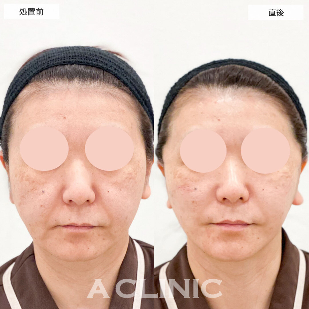 A式美肌たるみ切開でたるみが改善し若々しい印象に！こちら処置前と直後の症例です(40代女性)