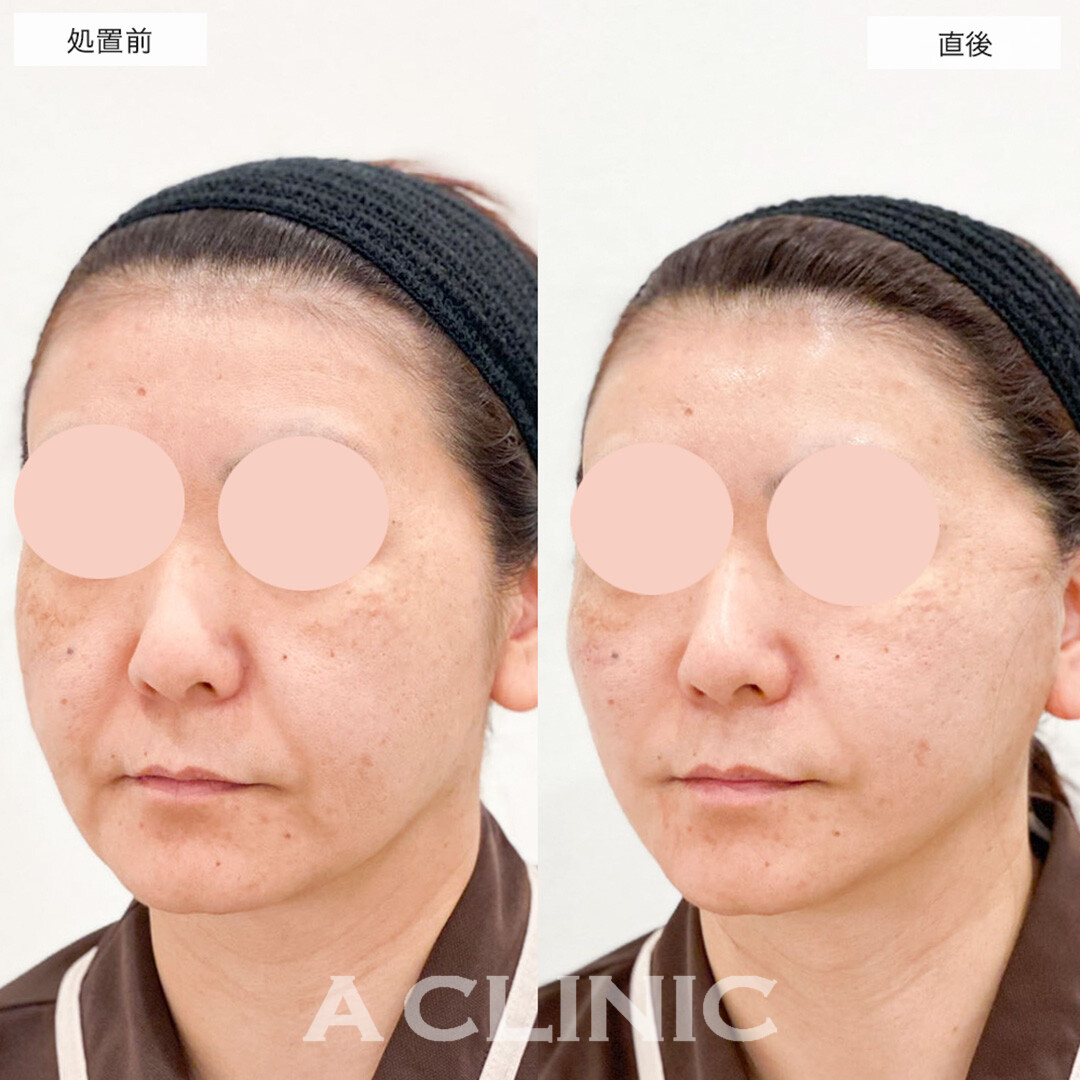 A式美肌たるみ切開でたるみが改善し若々しい印象に！こちら処置前と直後の症例です(40代女性)
