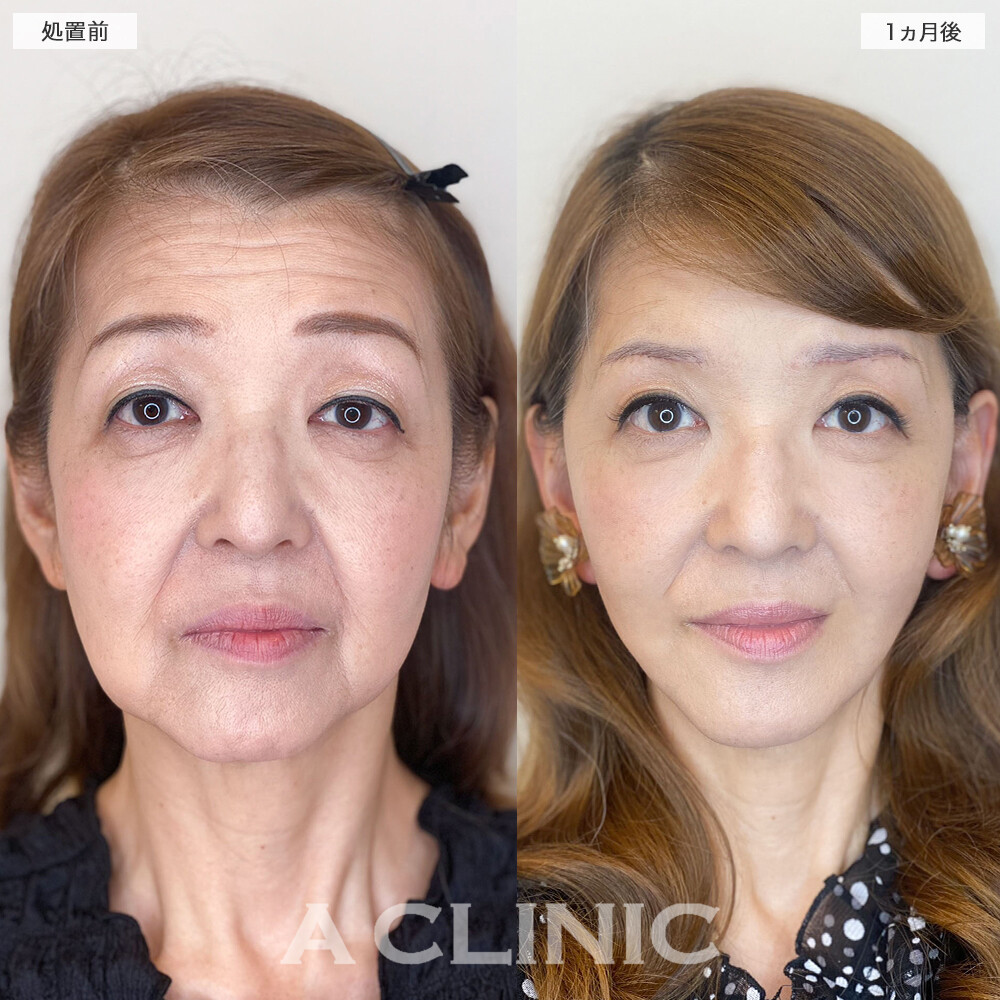 複合施術で顔のたるみが消えて若返り成功！1day小顔脂肪吸引の処置前と直後と1週間後と1ヵ月後の症例です(60代女性)