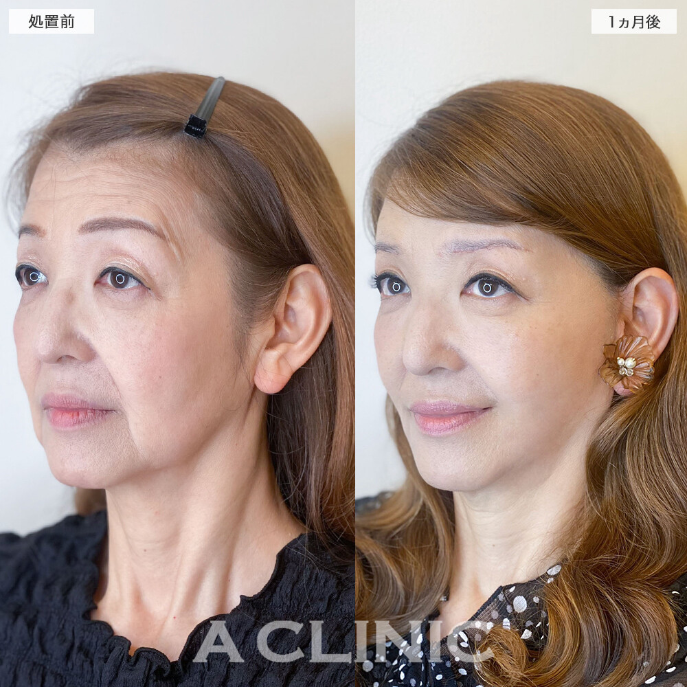 複合施術で顔のたるみが消えて若返り成功！1day小顔脂肪吸引の処置前と直後と1週間後と1ヵ月後の症例です(60代女性)