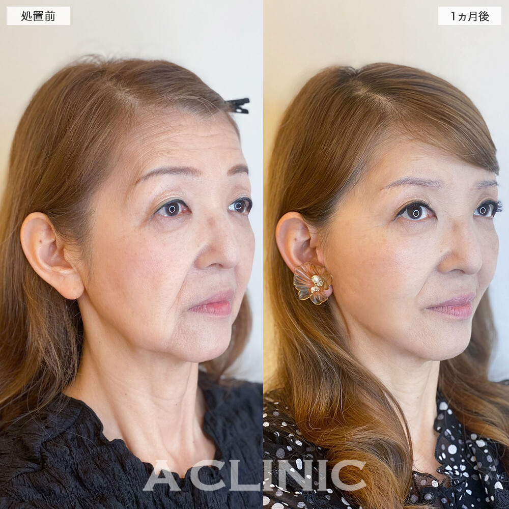 複合施術で顔のたるみが消えて若返り成功！1day小顔脂肪吸引の処置前と直後と1週間後と1ヵ月後の症例です(60代女性)