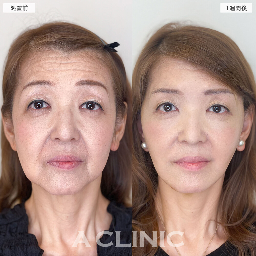 複合施術で顔のたるみが消えて若返り成功！1day小顔脂肪吸引の処置前と直後と1週間後と1ヵ月後の症例です(60代女性)
