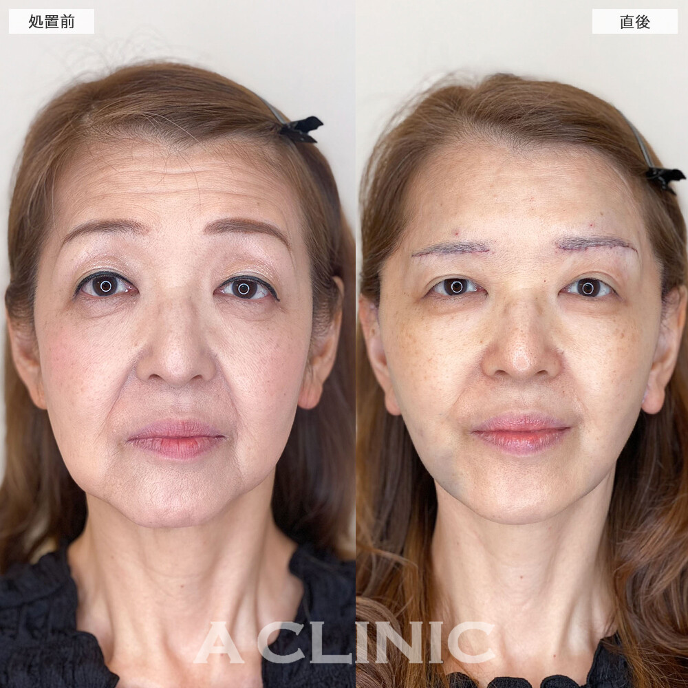 複合施術で顔のたるみが消えて若返り成功！1day小顔脂肪吸引の処置前と直後と1週間後と1ヵ月後の症例です(60代女性)