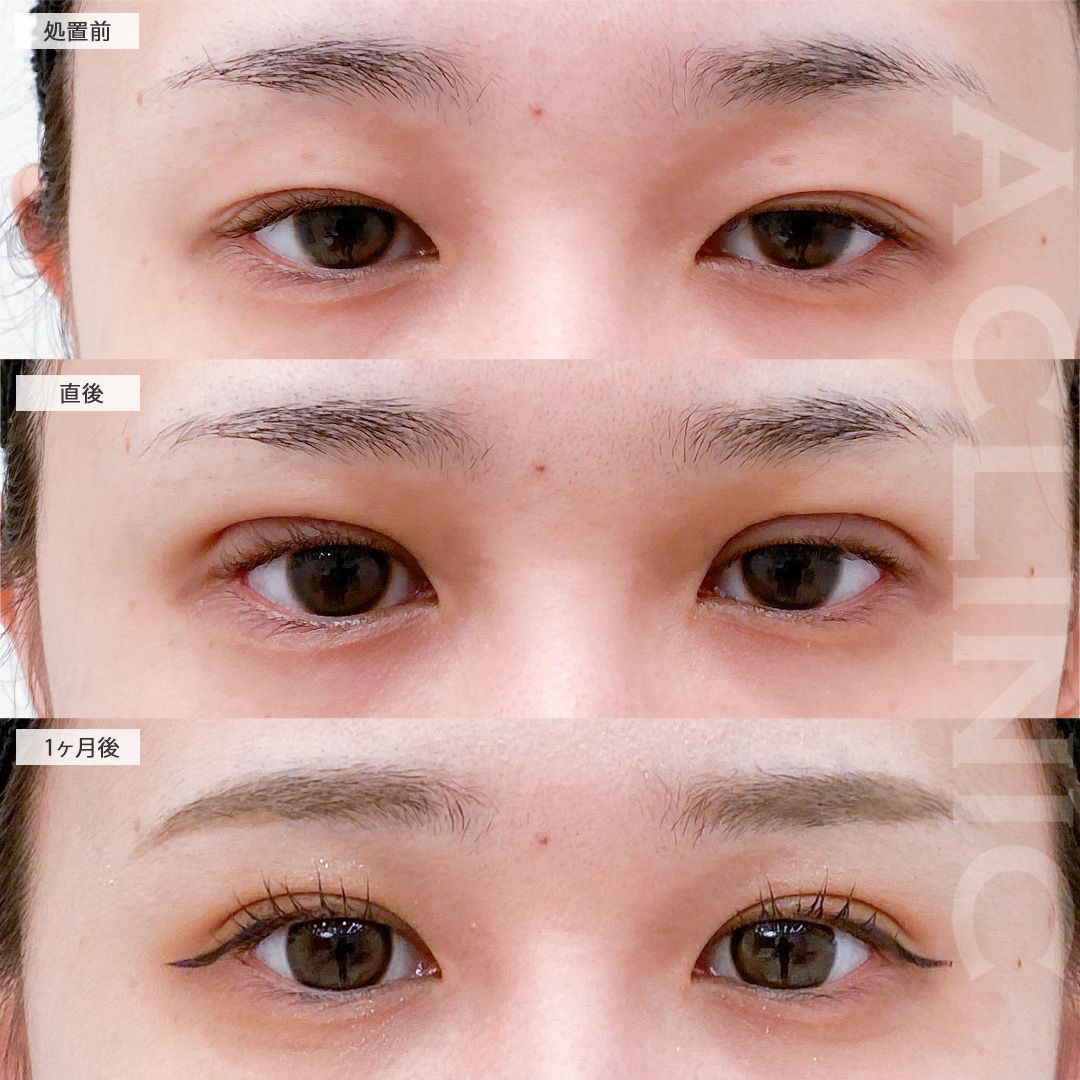 二重術埋没法で眠たそうな目元からメイク映えする二重に！処置前から1ヶ月後の症例です(20代症例です)