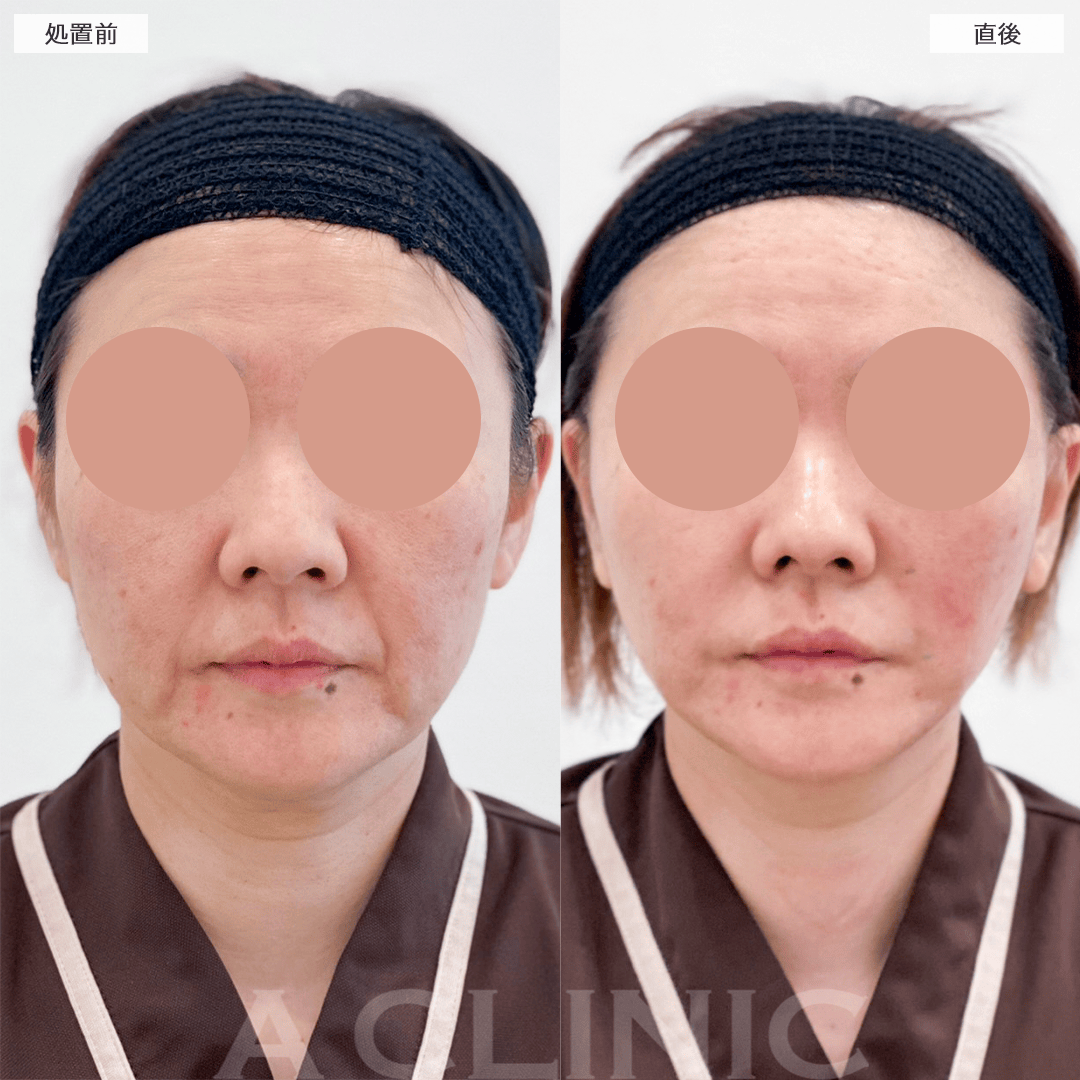 たるんだ皮膚を切開してリフトアップ！A式美肌たるみ切開の処置前と直後の症例です(40代女性)