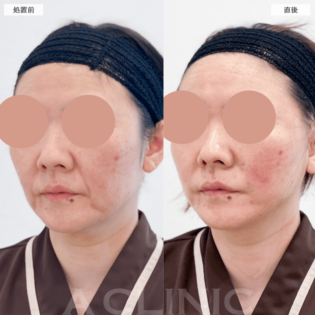 たるんだ皮膚を切開してリフトアップ！A式美肌たるみ切開の処置前と直後の症例です(40代女性)