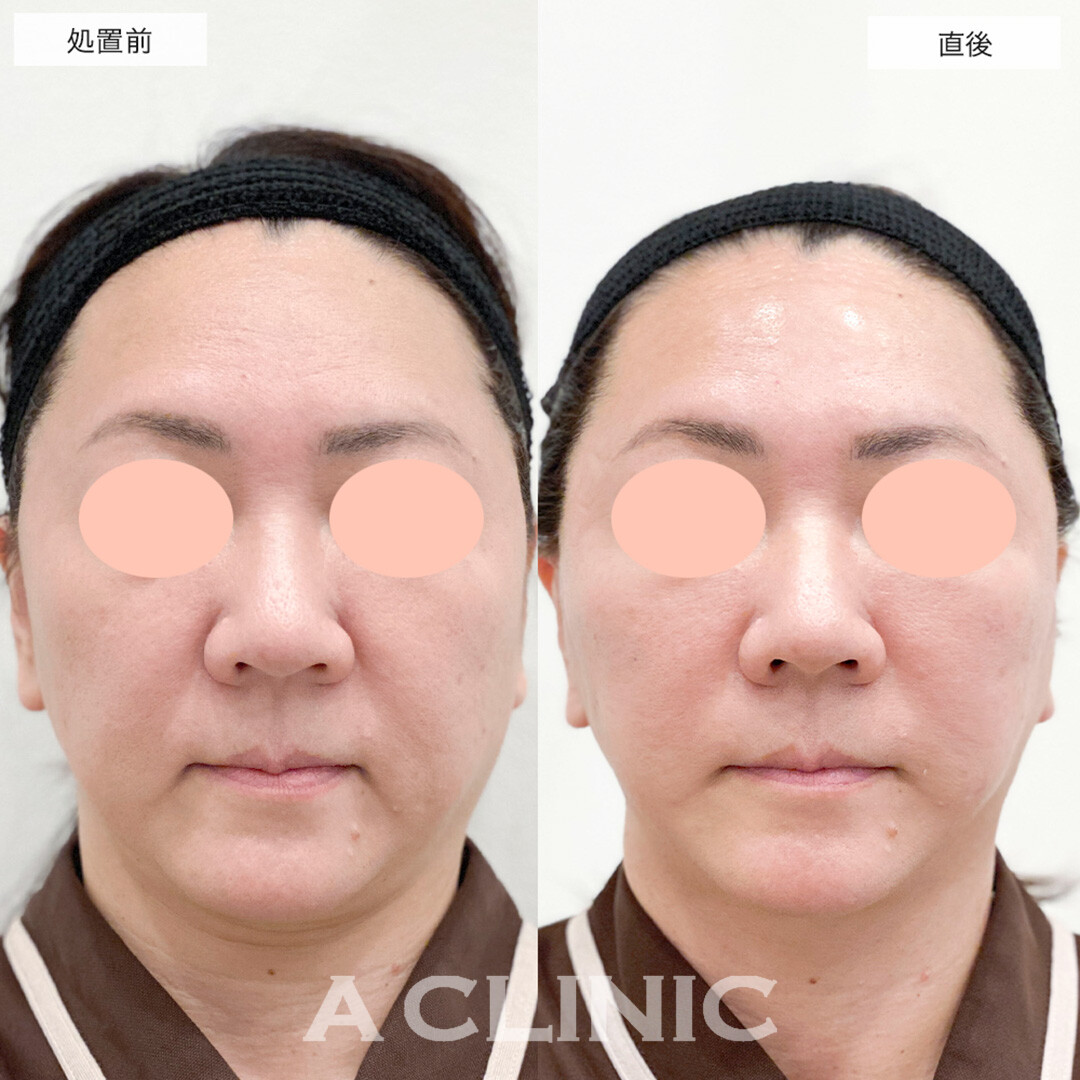 たるみを根本から改善します！こちらA式美肌たるみ切開の処置前と直後の症例です(50代女性)