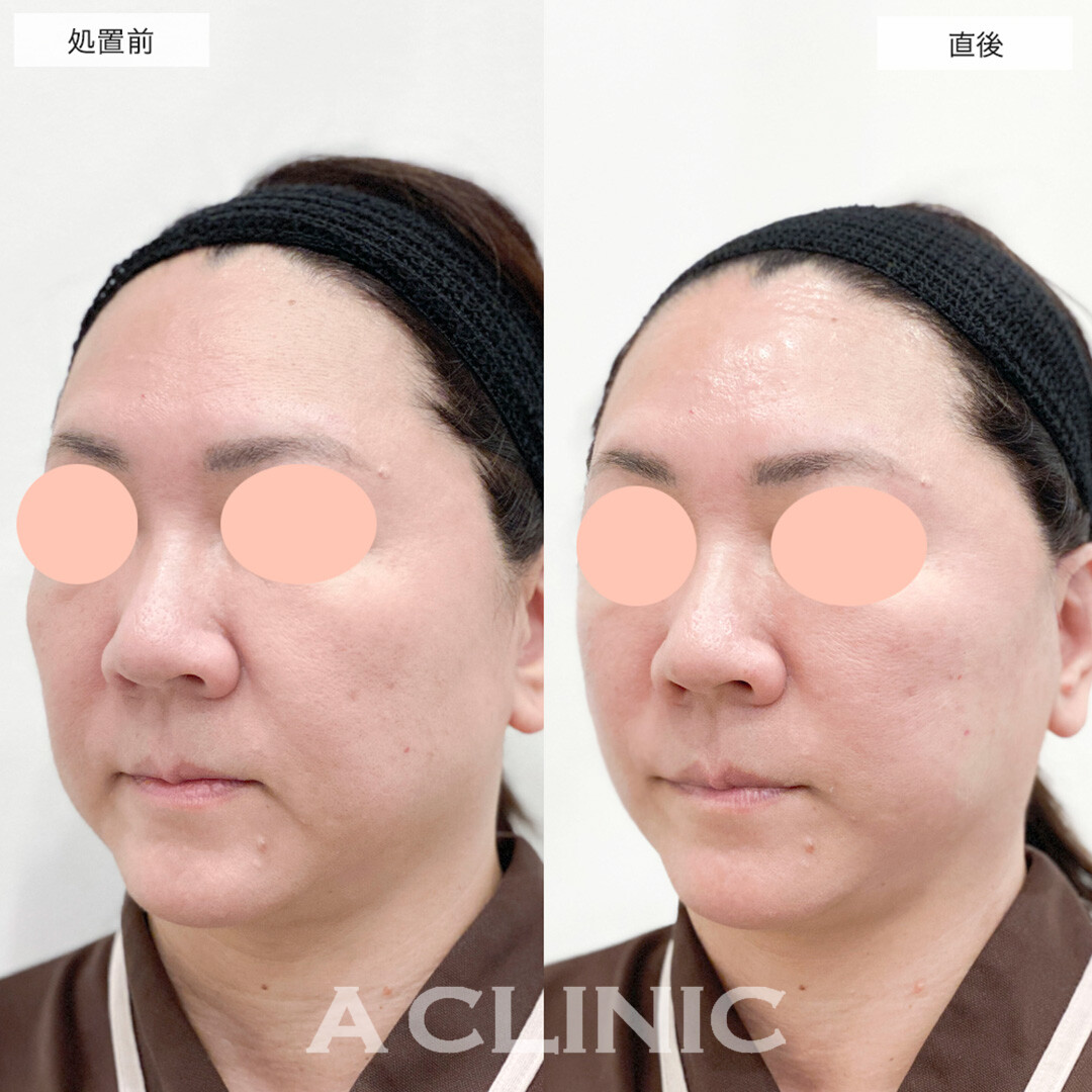 たるみを根本から改善します！こちらA式美肌たるみ切開の処置前と直後の症例です(50代女性)