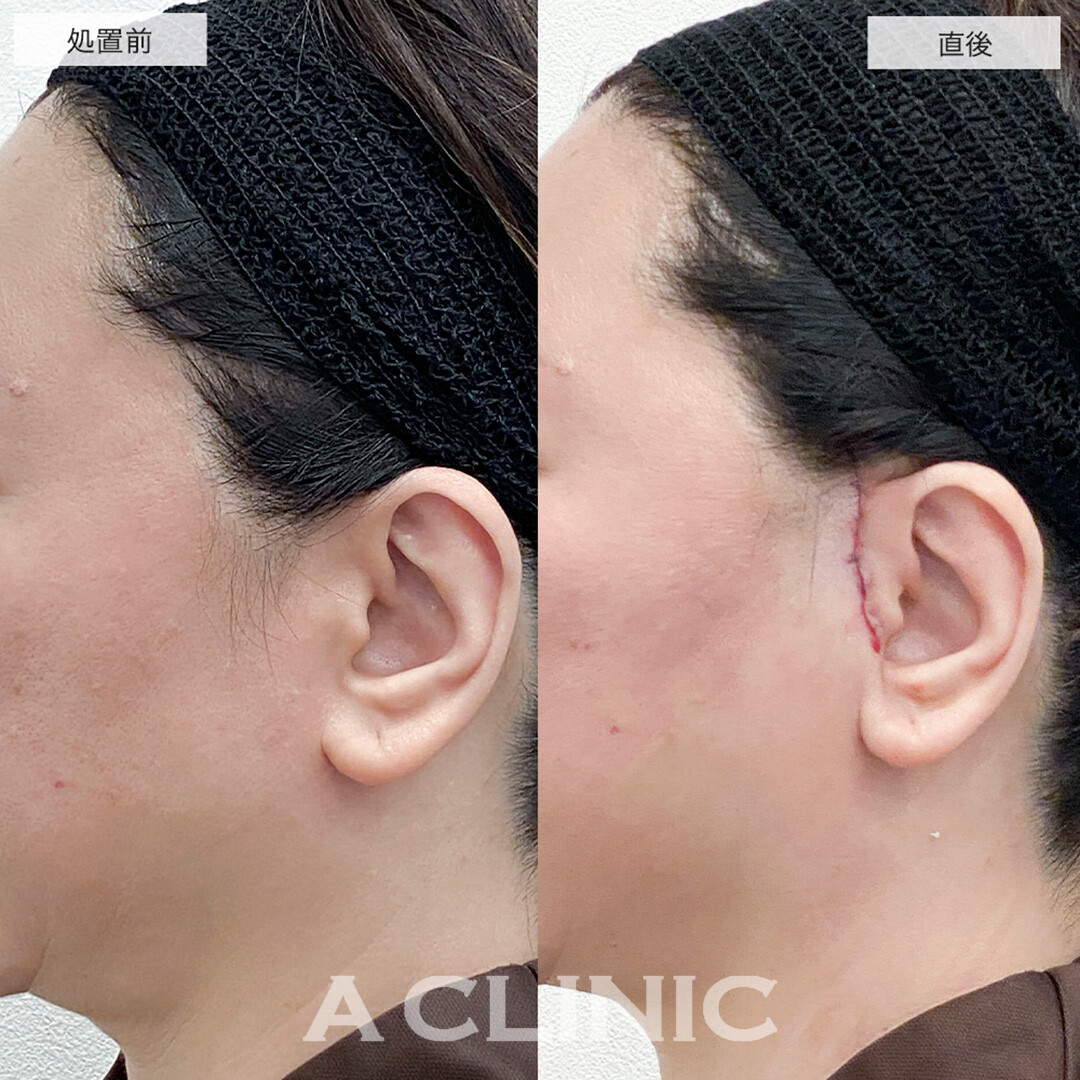 たるみを根本から改善します！こちらA式美肌たるみ切開の処置前と直後の症例です(50代女性)