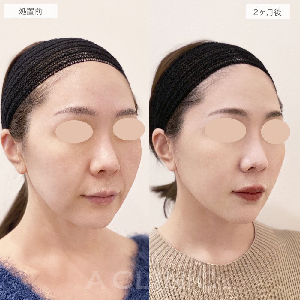 【直後の傷跡あり】マリオネットライン撲滅！A式美肌たるみ切開の処置前と2ヶ月後の症例です(30代女性)