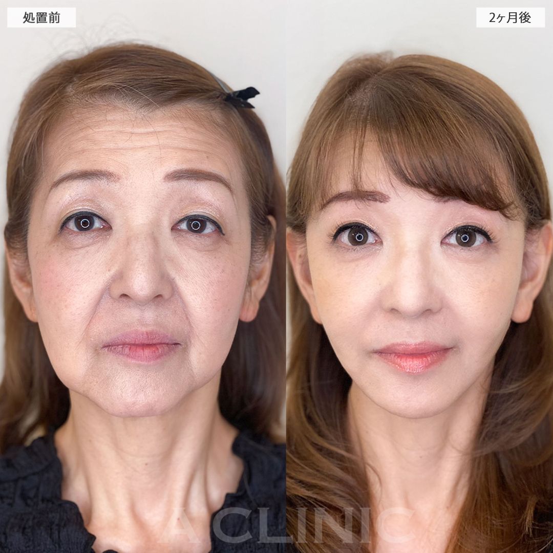 複合施術で最強若返り！！こちら処置前と2ヶ月後の症例です(60代女性)