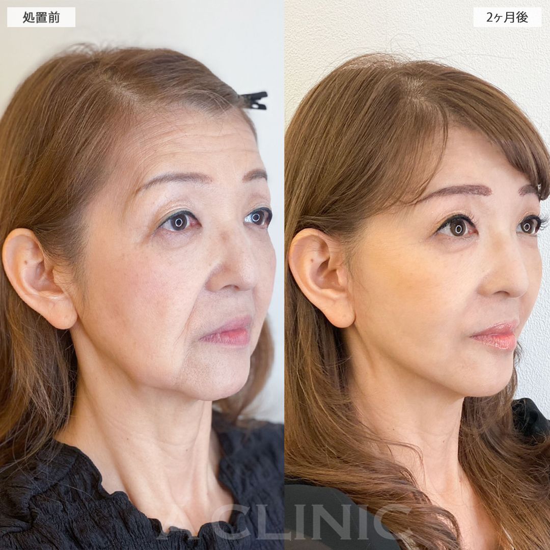 複合施術で最強若返り！！こちら処置前と2ヶ月後の症例です(60代女性)