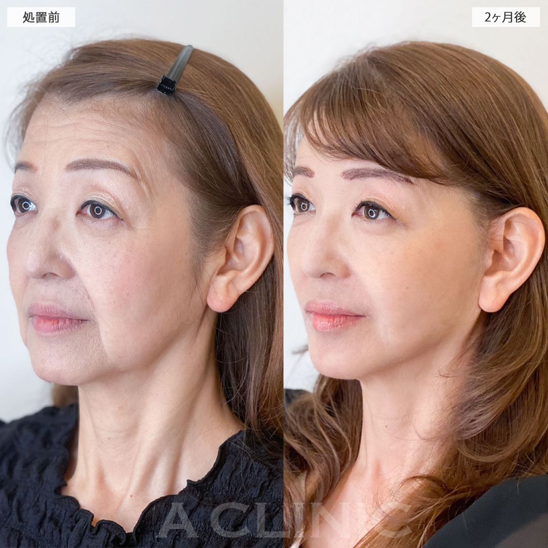 複合施術で最強若返り！！こちら処置前と2ヶ月後の症例です(60代女性)