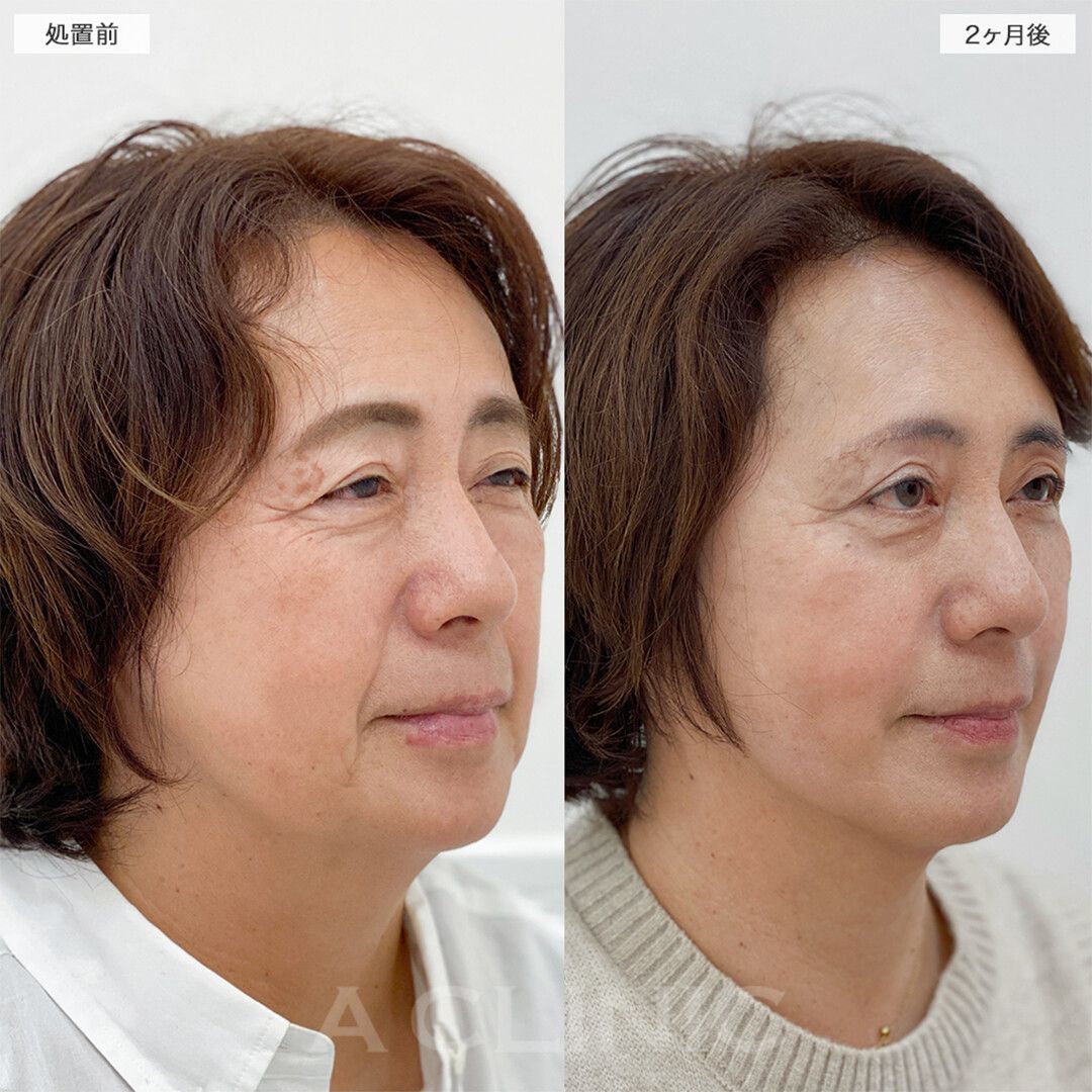 毎日鏡を見るのが楽しいです！こちら1day小顔脂肪吸引の処置前と2ヶ月後の症例です(50代女性)