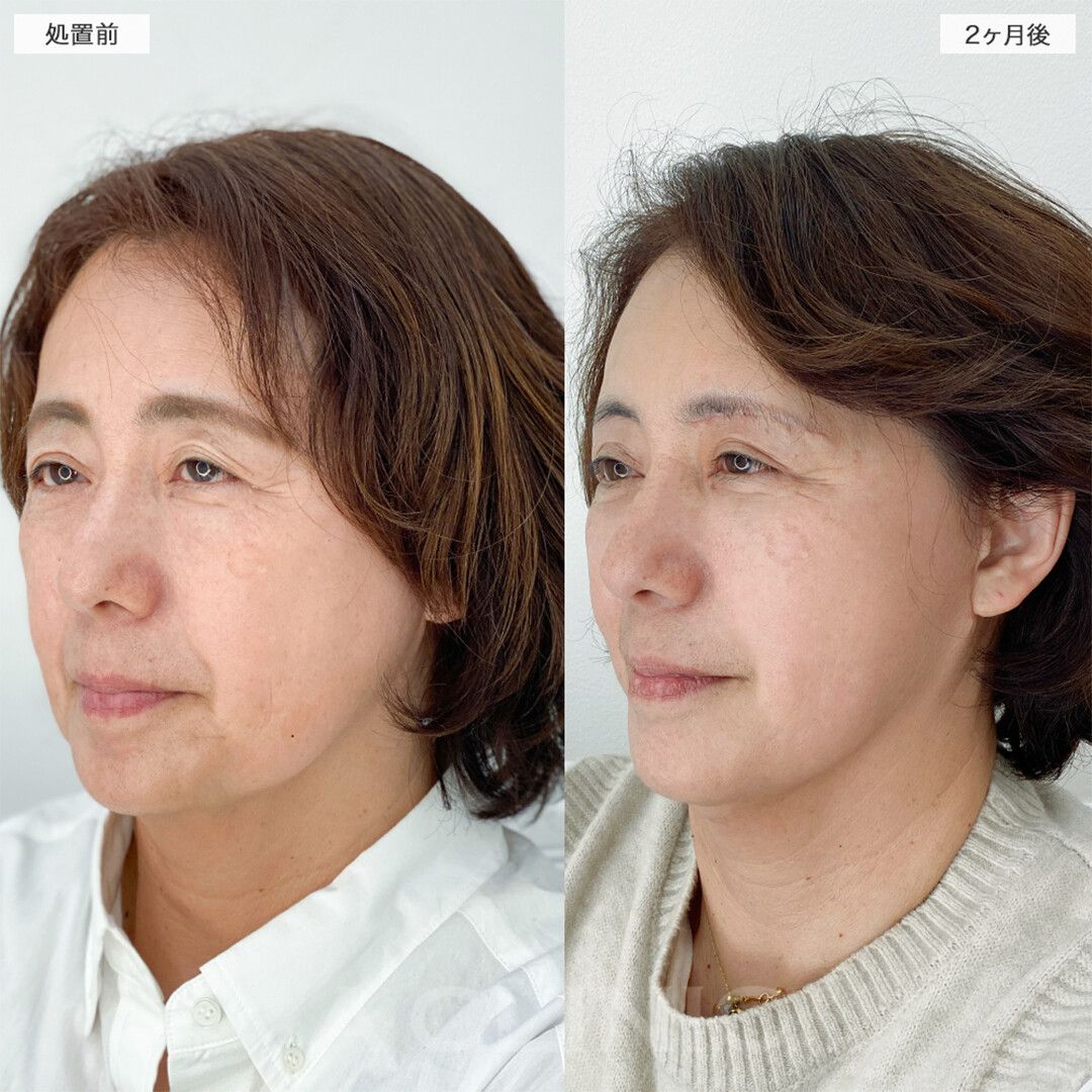 毎日鏡を見るのが楽しいです！こちら1day小顔脂肪吸引の処置前と2ヶ月後の症例です(50代女性)