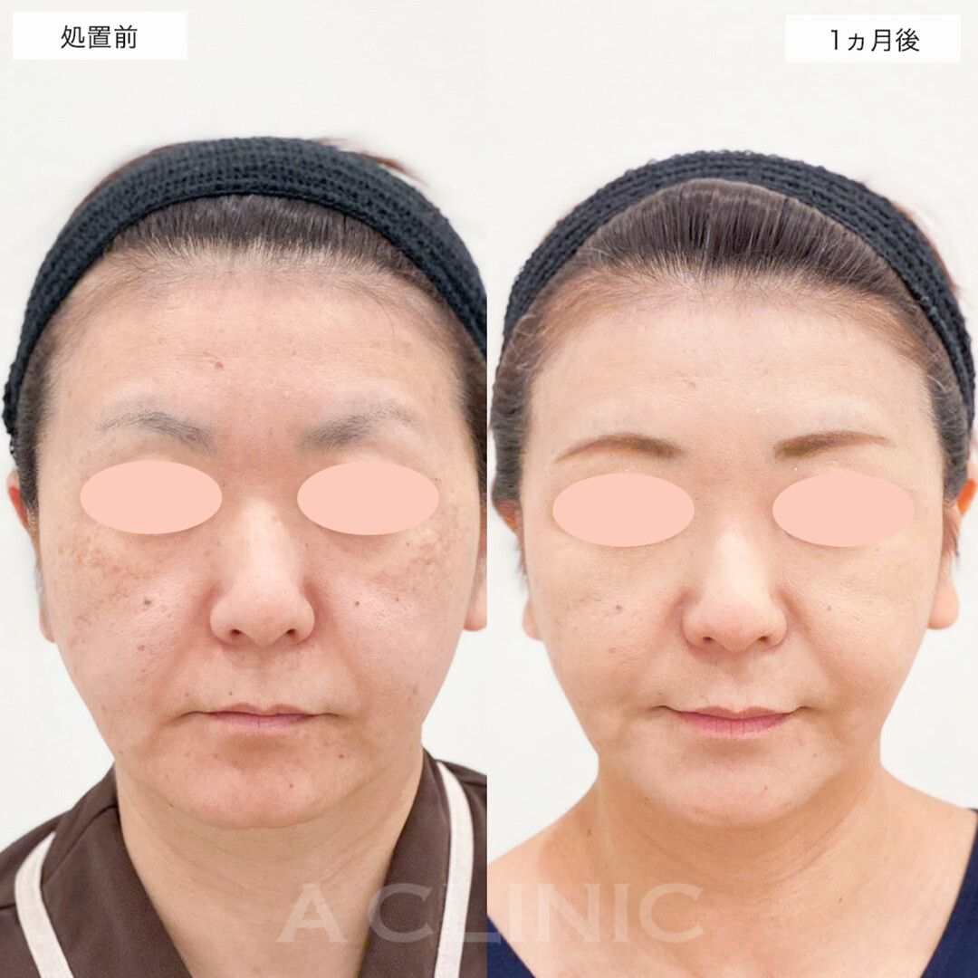 A式美肌たるみ切開で自信が持てるフェイスラインになりました！こちら処置前と1ヵ月後の症例です(40代女性)