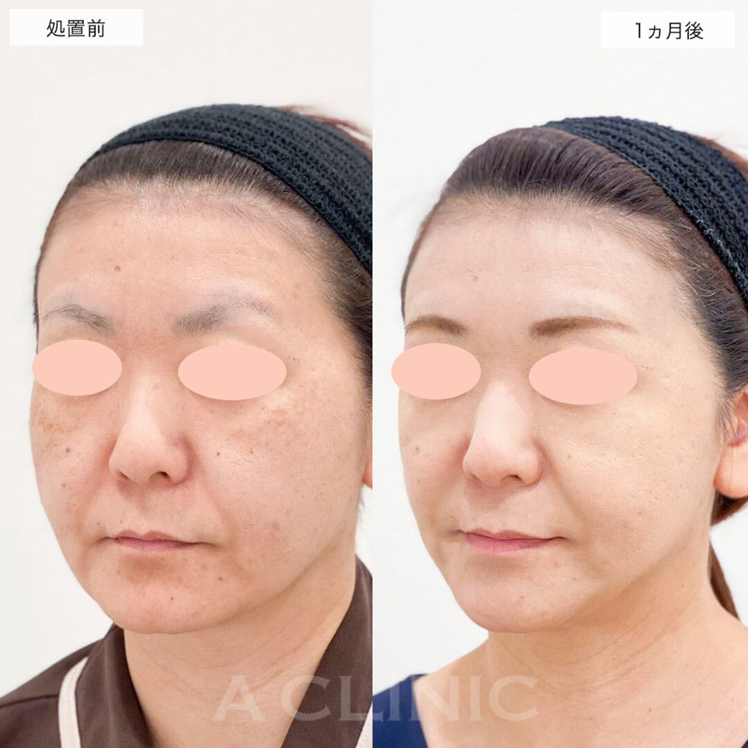 A式美肌たるみ切開で自信が持てるフェイスラインになりました！こちら処置前と1ヵ月後の症例です(40代女性)