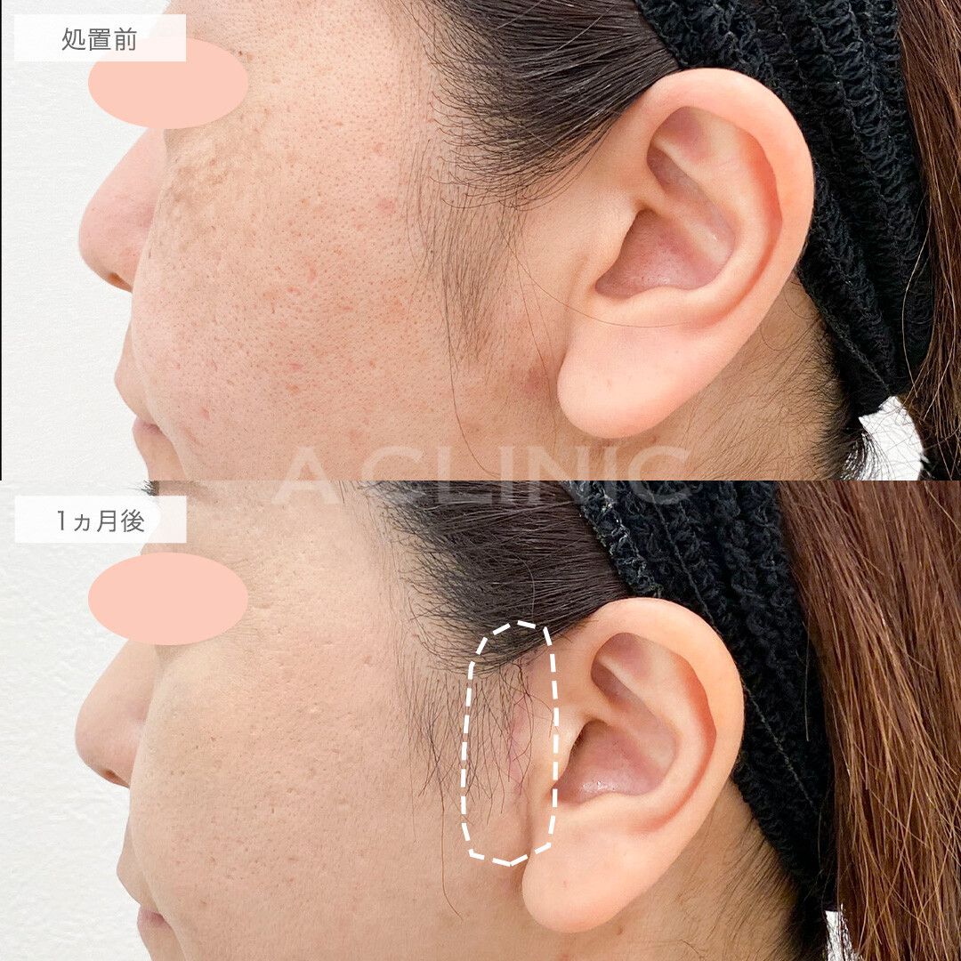 A式美肌たるみ切開で自信が持てるフェイスラインになりました！こちら処置前と1ヵ月後の症例です(40代女性)