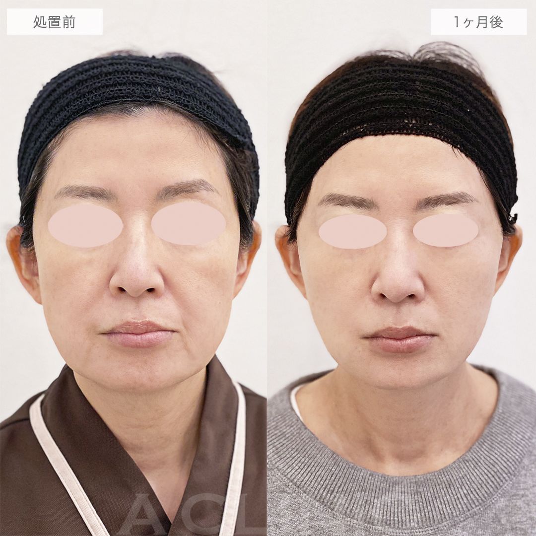 面長を解消して若返りました！A式美肌たるみ切開の処置前と1ヶ月後の症例です(50代女性)