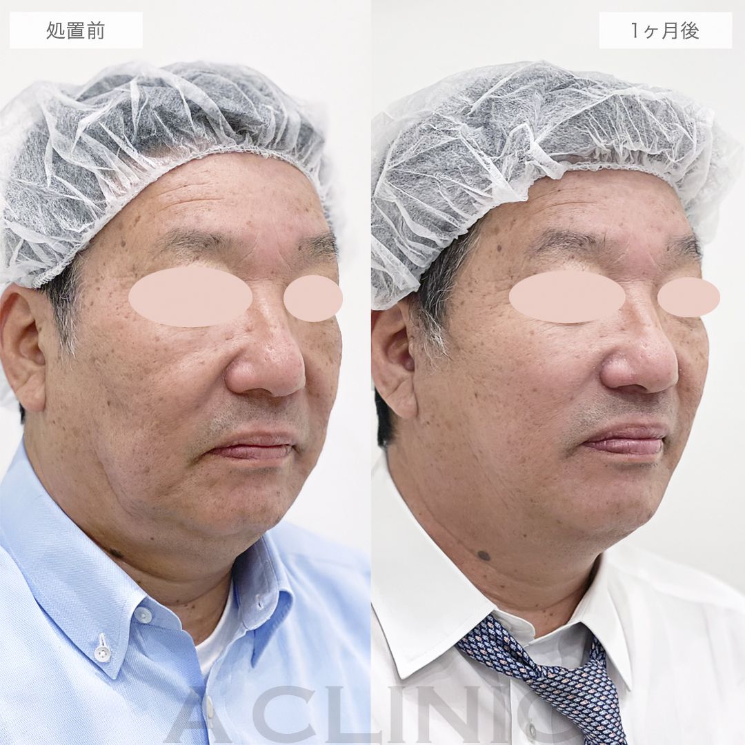 フェイスラインのもたつきがリフトアップして若返りました！A式美肌たるみ切開の処置前と1ヶ月後の症例です(60代男性)
