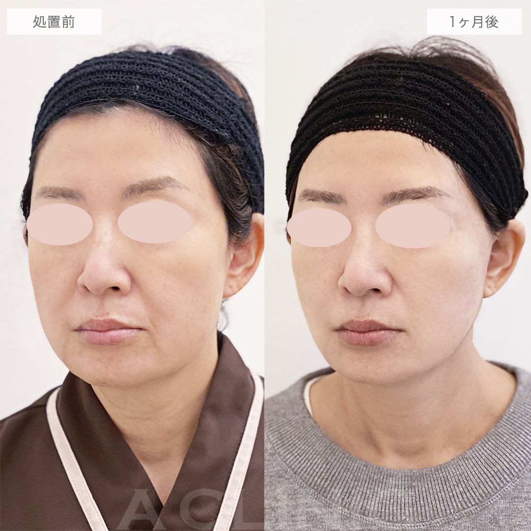 面長を解消して若返りました！A式美肌たるみ切開の処置前と1ヶ月後の症例です(50代女性)