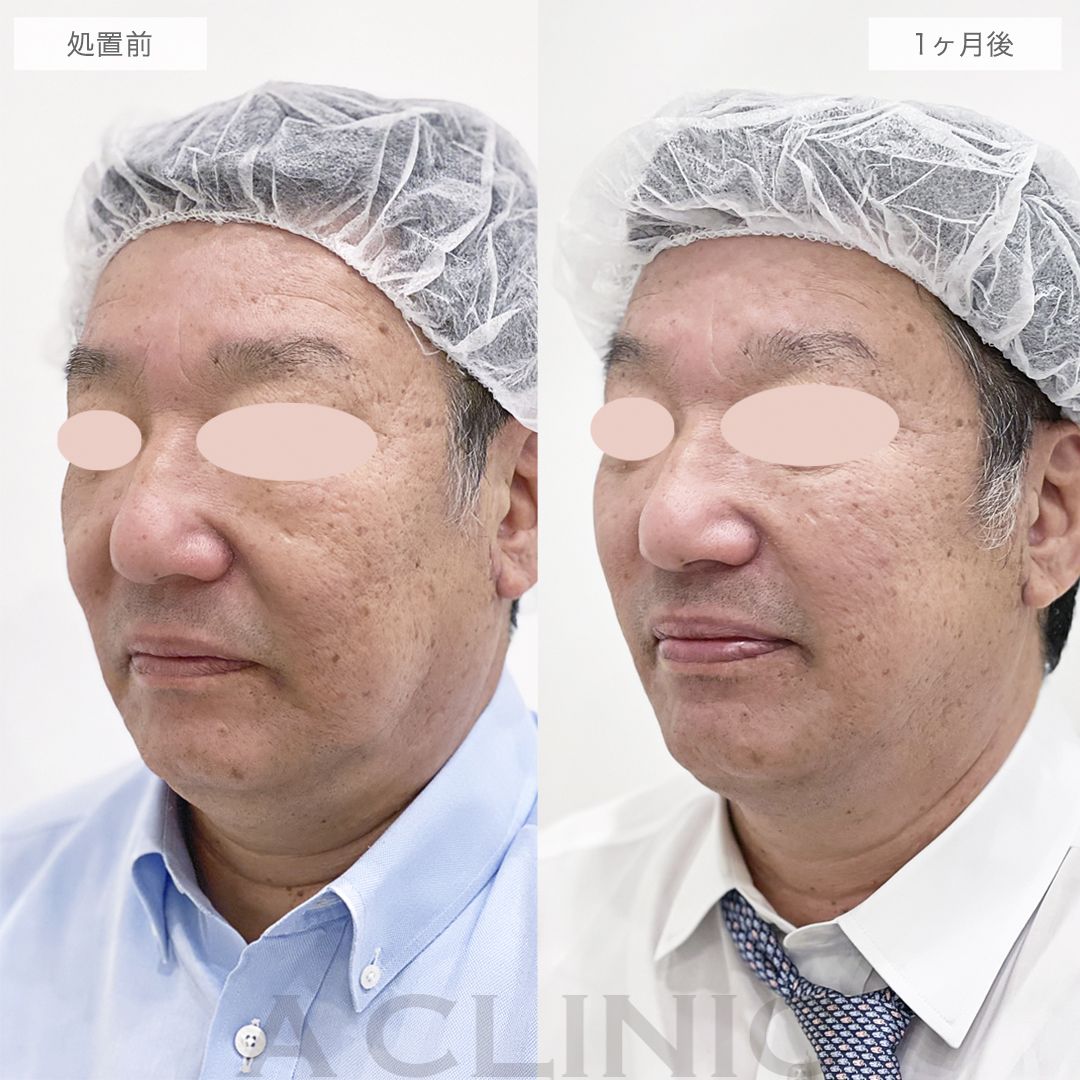フェイスラインのもたつきがリフトアップして若返りました！A式美肌たるみ切開の処置前と1ヶ月後の症例です(60代男性)
