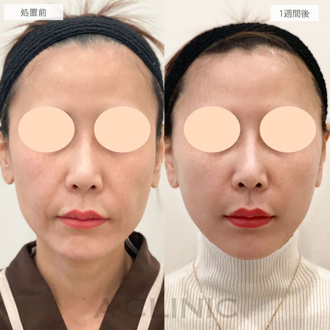 たるみ改善で一気に若返り！こちらA式美肌たるみ切開の処置前と1週間後の症例です(30代女性)