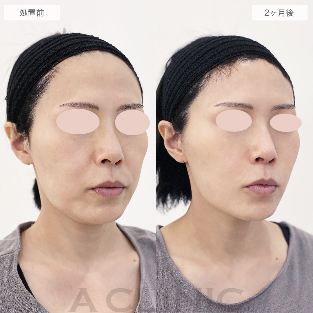 口元のもたつきが解消して若返りました！A式美肌たるみ切開の処置前と2ヶ月後の症例です(40代女性)
